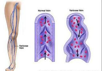 Prevención de venas varicosas en las piernas. Ejercicios para las piernas. Una prenda de compresión para varicosa