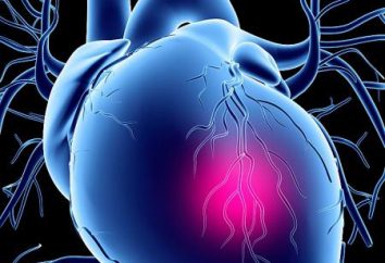 cardiopatia ischemica – che cos'è? Cause, sintomi e metodi di trattamento