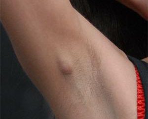 Warum vergrößerte Lymphknoten unter dem Arm, und wie sie zu behandeln?