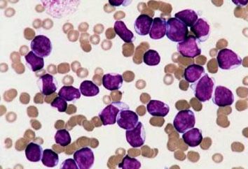 Leucemia – O Que É? Descrição da doença, causas, diagnóstico, prognóstico