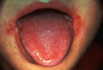 Zapalenie jamy ustnej u dzieci: objawy i leczenie