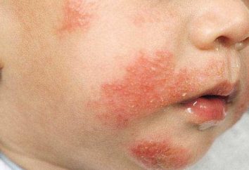 A dermatite atópica é uma criança: causas, sintomas, tratamento