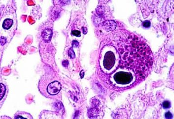 Zakażenie wirusem cytomegalii: objawy u kobiet. Przyczyny i leczenie zakażenia CMV