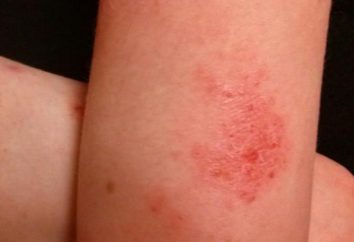 Eczema: quello che è, le cause di, e tipi di trattamento