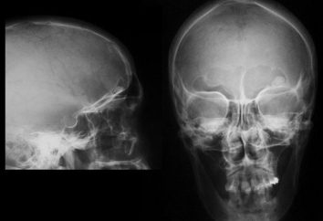 Kostniak kości osteoma: objawy, diagnoza i schemat leczenia