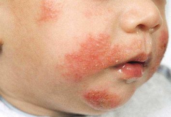 La dermatite atopique dans le traitement et les symptômes de l'enfant