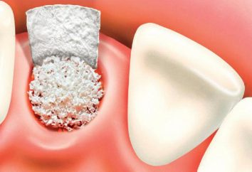 greffe osseuse avec des implants dentaires: avis
