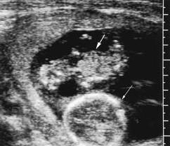 Zu welcher Zeit gibt Ultraschall Schwangerschaft?