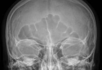 Czy konieczne rentgenowskie zatok nosa?