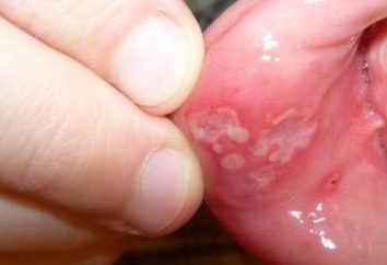 Zapalenie jamy ustnej – Leczenie u dorosłych