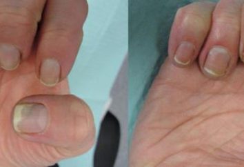 Kandydoza paznokci: objawy, leczenie