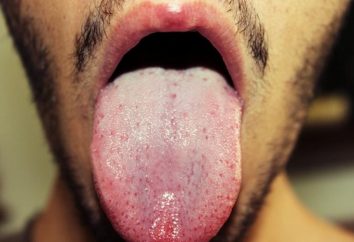 Scopri qual è la causa di macchie bianche sulla lingua negli adulti