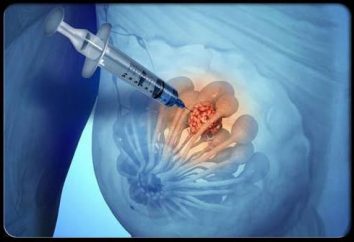 Biopsia mammaria – quello che è. Biopsia mammaria: indicazioni e caratteristiche della procedura