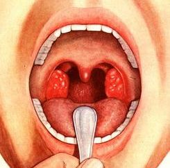 grundlegende Methoden: Wie Tonsillitis behandeln