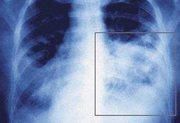 Pneumonia in einem Kind 2 Jahre: die Symptome und Zeichen