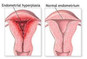 Curetaje en la hiperplasia endometrial: características, indicaciones y efectos