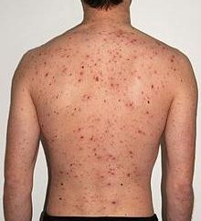 Come trattare la varicella negli adulti: alcune sottigliezze