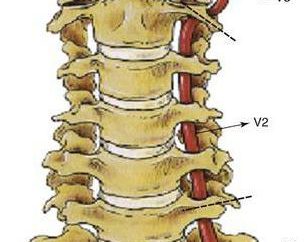 La sindrome dell'arteria vertebrale nella osteocondrosi cervicale: sintomi e trattamento