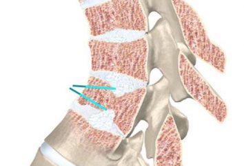 Osteochondroza kręgosłupa lędźwiowego: objawy i leczenie. Ćwiczenia, masaże, akupunktura