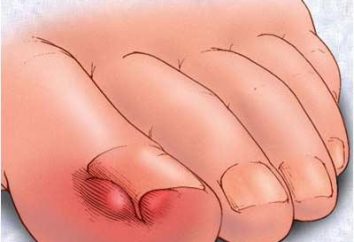 Las uñas encarnadas: causas, síntomas, tratamiento