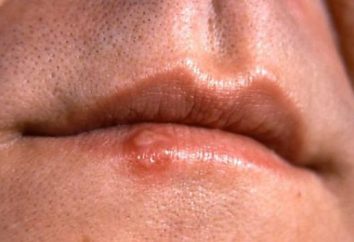 I sintomi del cancro della bocca – come riconoscerli?
