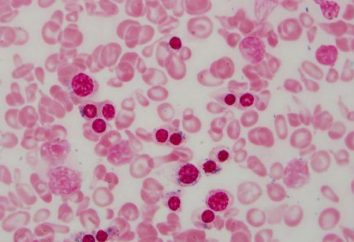 anemia sideroblástica: síntomas, tratamiento