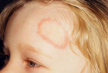 malattia Tigna in un bambino: sintomi, metodi di trattamento e prevenzione