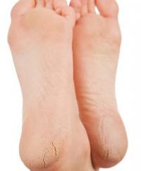 Was die Füße sagen: rissige Fersen diese gefährliche Krankheit geben