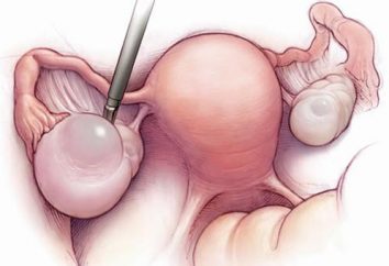 A remoção de quistos ovarianos
