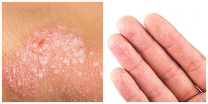 Eczema Crónico Causas Síntomas Y Tratamiento