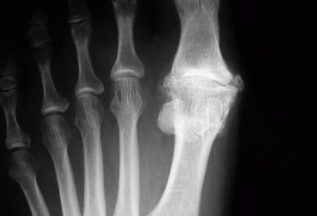 Arthrose du pied: causes, symptômes et méthodes de traitement