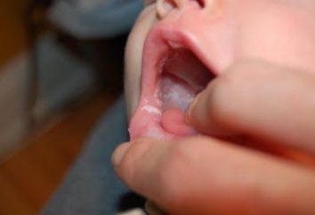 Che cosa significa la macchie bianche sulla lingua nei neonati
