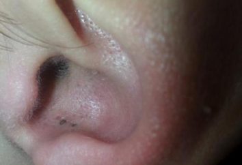 Czarna kropka w uchu: przyczyny, jak się pozbyć