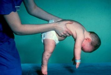 síndrome de Kartagener em crianças: diagnóstico, foto, o tratamento