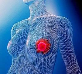 El cáncer de mama, Paso 2a: pronóstico. Tratamiento del cáncer de mama en fase 2a?