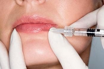Comment est l'augmentation des lèvres avec de l'acide hyaluronique? Procédure d'examen au fond positif