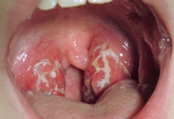 Úlceras en las amígdalas sin temperatura: la imagen, el tratamiento