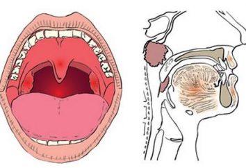 tonsillite cronica: tonsille del bambino