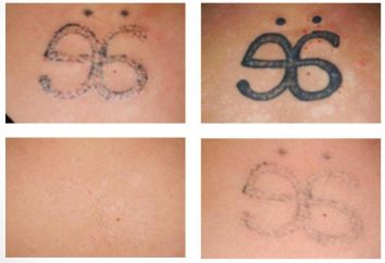 Livrar-se dos erros do passado: Laser tatuagem remoção