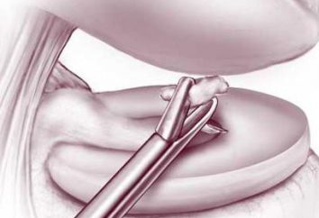 Souris joint articulaire du genou: le traitement, l'élimination