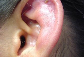 Ochrzęstna ucha: objawy, leczenie, zdjęcia