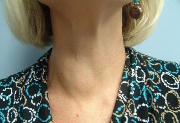 Tiroide cisti – è pericoloso? Il trattamento delle cisti della tiroide
