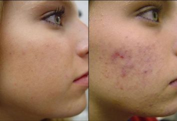 Nous trouvons la réponse à la question: « Comment se débarrasser de l'acné du jour au lendemain »