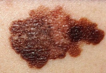 El diagnóstico de melanoma: Métodos, comentarios