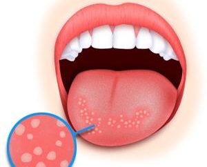 Geschwüre auf der Zunge und ihre Behandlung