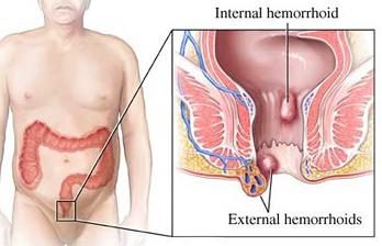 Hemorrhoid: Löschen und andere Therapien. Die Entfernung von Hämorrhoiden durch eine Operation