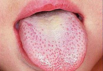 leukoplakia język: przyczyny, objawy, leczenie