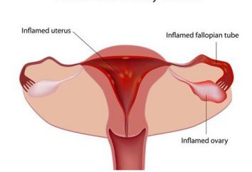 Salpingofobitis y embarazo: ¿cuáles son las consecuencias? Salpingooporitis – ¿qué es? Salpingofarmitis: tratamiento