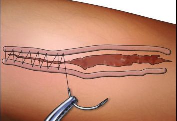 suturas quirúrgicas: tipos y métodos de mezcla