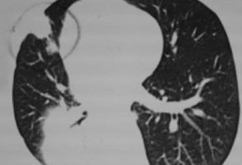polmonite basale: sintomi e trattamento. L'inalazione di polmonite